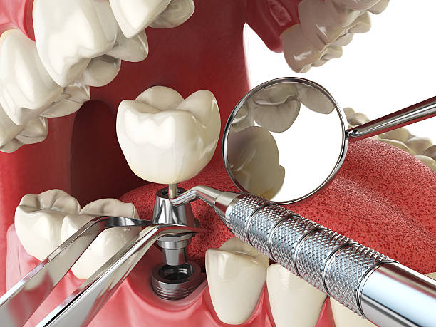 Best Emergency Denture Repair in Logan, IA